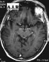 encefalopatia acuta di werincke t1 sag gad.jpg (37834 byte)