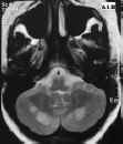 encefalopatia ipertensiva FLAIR cervelletto.jpg (41515 byte)