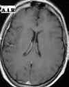 encefalopatia ipertensiva T1 gad.jpg (35804 byte)