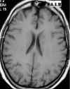 encefalopatia ipertensiva T1.jpg (40045 byte)