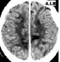 encefalopatia ipertensiva TC con.jpg (43879 byte)