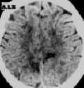 encefalopatia ipertensiva TC.jpg (43743 byte)