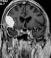 meningioma con cor.jpg (48339 byte)