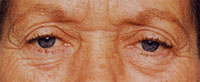 Blefaroplastica: chirurgia estetica occhi
