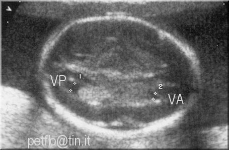 ventricoli cerebrali_21w.jpg