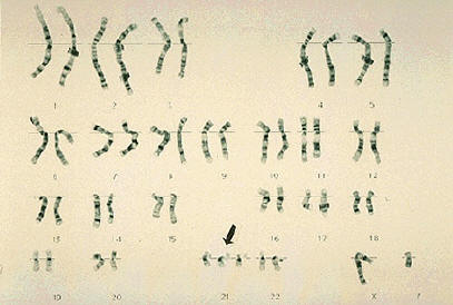 Mappa Cromosomica della Trisomia 21