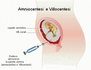Amniocentesi e Villocentesi