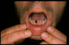Ulcera aftosa