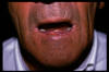 Carcinoma del labbro inferiore