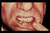 Carcinoma del labbro inferiore 