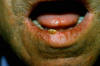 Carcinoma del labbro inferiore 