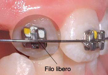 prima della legatura del filo ortodontico
