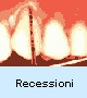 recessioni gengivali