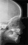 teleradiografia latero-laterale del cranio