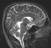 MRI del cranio Umano