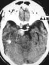 aneurisma cerebrale media2.jpg (36762 byte)