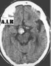 aneurisma cerebrale media3.jpg (33253 byte)