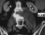 aneurisma cronico aorta add 5.jpg (34724 byte)