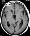 idrocefalo 3 ventr.meningioma T1.jpg (34581 byte)