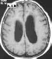 idrocefalo 3 ventr meningioma T1.jpg (25777 byte)