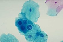 Pap Test: Cellula ASCUS in mezzo a cellule normali