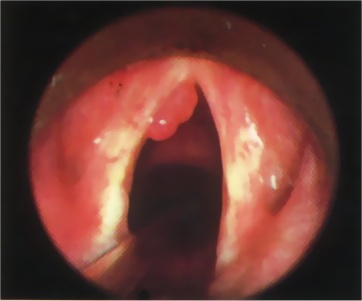 Papillomatosi HPV delle corde vocali