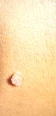 Verruca cutanea da virus HPV