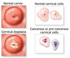 Displasia Cervicale