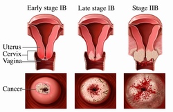 Progressione del cancro del collo uterino