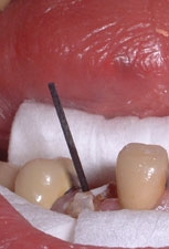 fase del restauro del moncone= width=